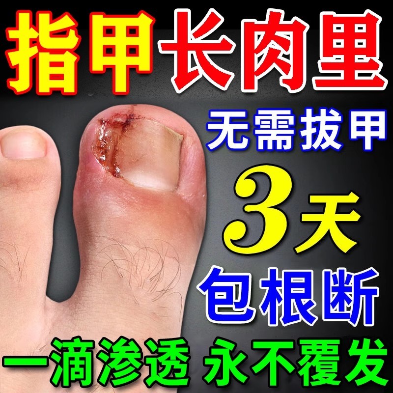 化北京同仁堂甲沟炎息肉去除专用膏药脚大拇指消肿去肉芽脓软化剂