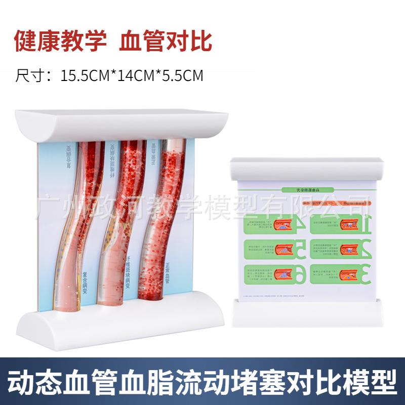 动态高血脂血管堵塞对比模型态病理血管对比模型浓稠度对比教学