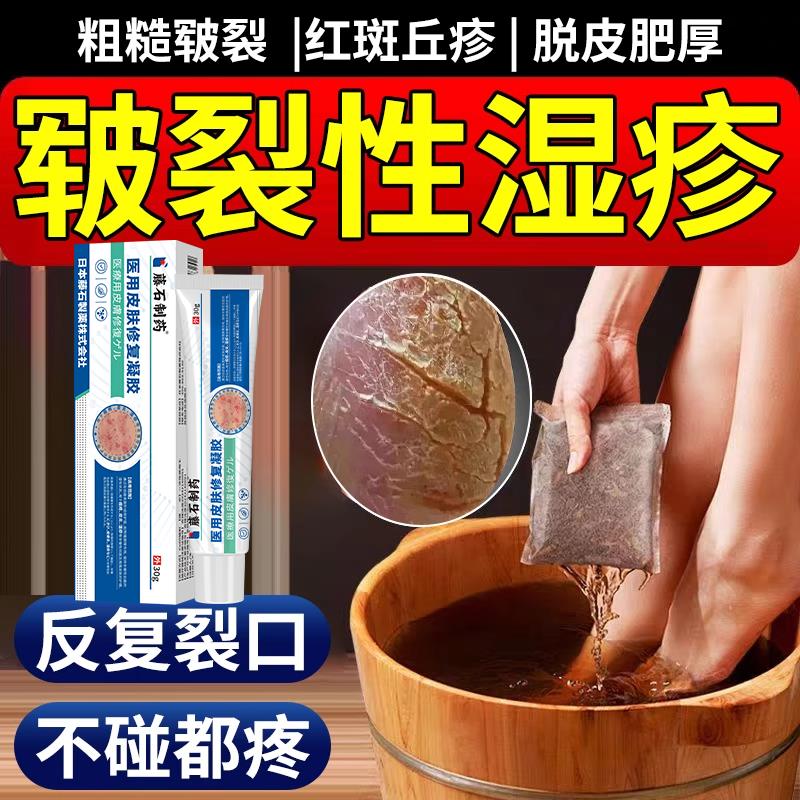 脚上水泡疹止痒去湿角化皲裂性湿疹泡脚药包皮肤止痒皮炎CA医星熊