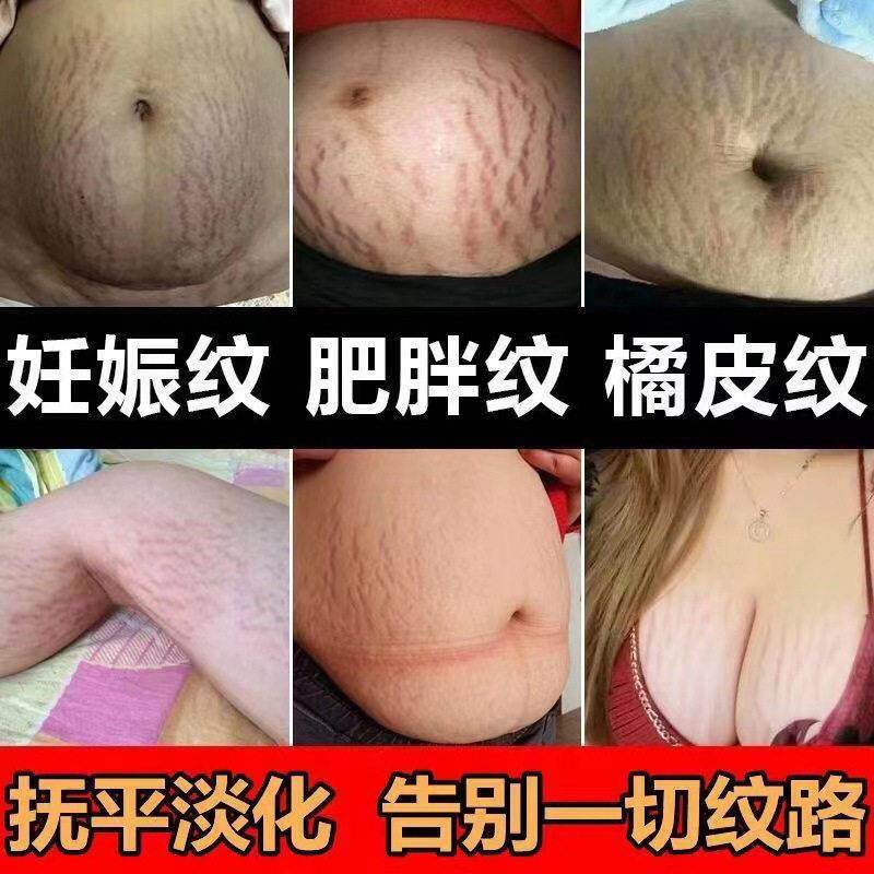妊娠纹修护霜产后去孕纹淡化胖纹预防生长纹孕妈修复紧致疤痕膏