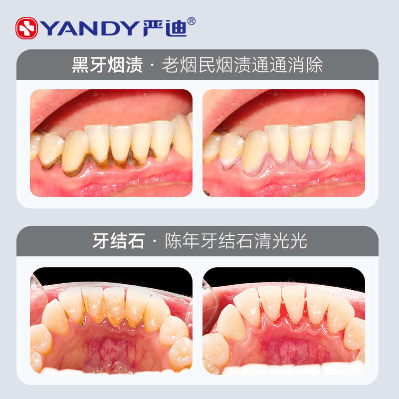 严迪牙结石去除器超声波洗牙器牙齿污垢电动清洁牙垢洁牙仪神器