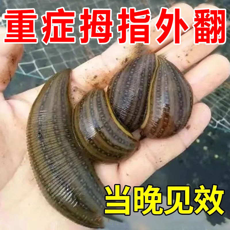 【专业技术冶拇外翻】拇指外翻矫正贴脚趾重叠防磨大脚骨专用药FF