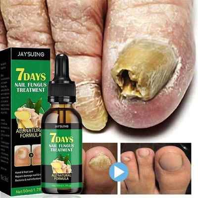7 Days Nail Fungal Treatment Essence Oil Foot Toe Nail Fungu