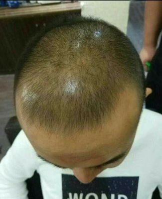 半岛激光生发帽怎么样?谈谈用后一些建议及看法