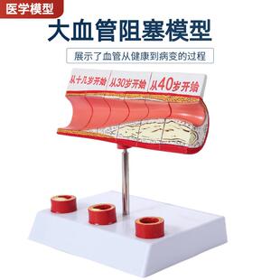 人体血管堵塞动支脉粥样硬化心血管硬化模具演变过程血管病理模型