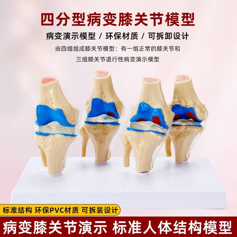 仿真人体四阶段病理膝关节骨骼结构解剖模型肌肉展示膝盖骨质教具