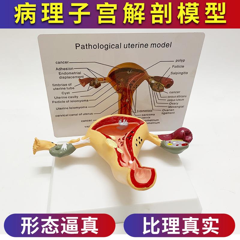 人体女性生殖子宫解剖病理模型 阴道卵巢教学模型 妇科生殖科教具