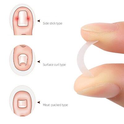 10PCS Ingrown Toe Nail Treatment Ingrown Toenail Correction