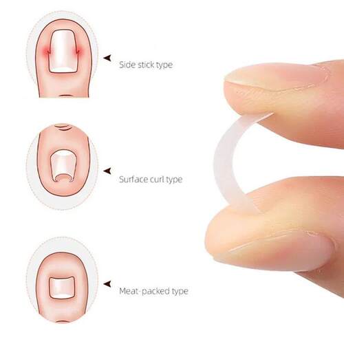 10PCS Ingrown Toe Nail Treatment Ingrown Toenail Correction