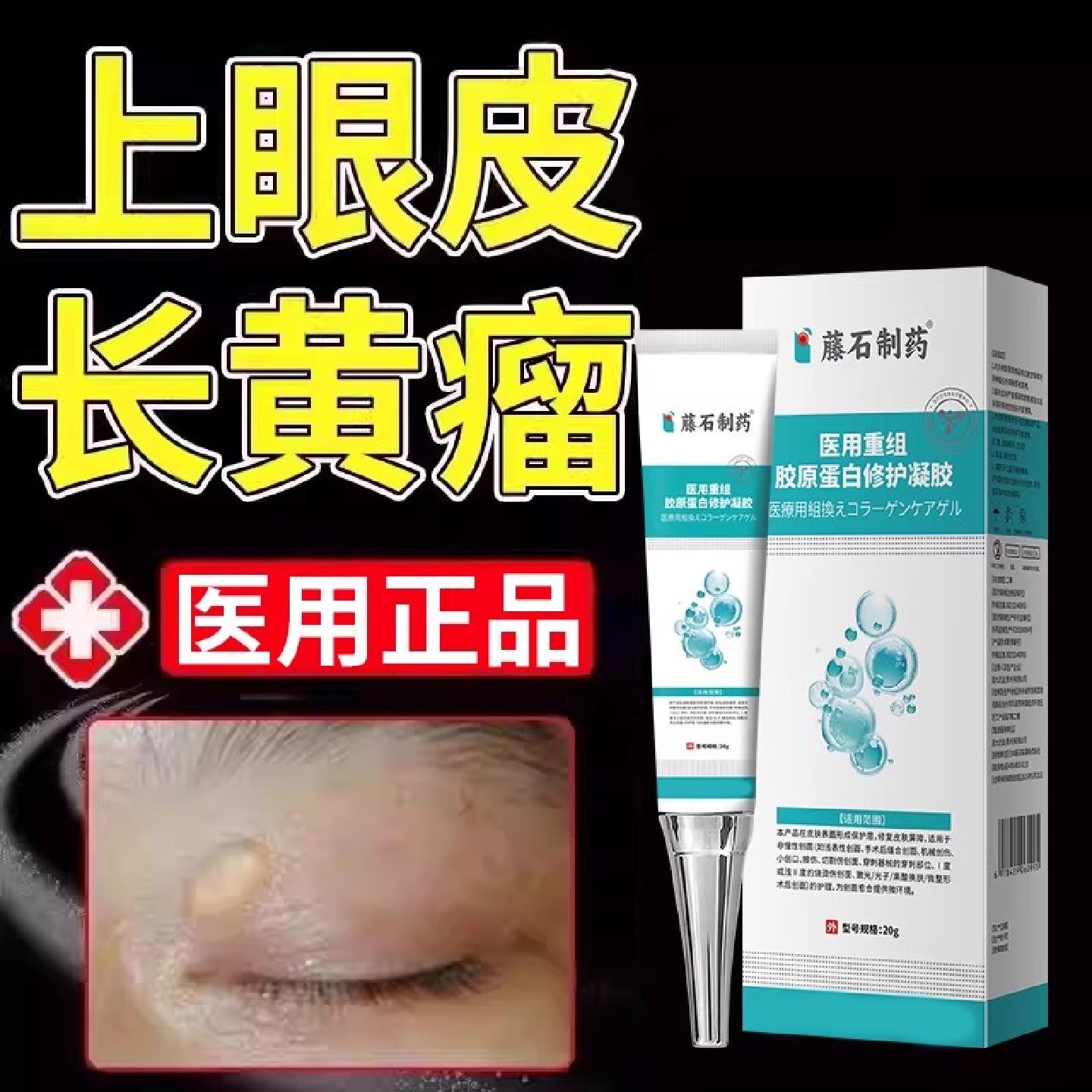 去除眼皮黄疣眼脸眼角长黄瘤三氯醋酸软膏睑黄疣黄色瘤黄斑女性SK