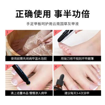 南云国草甲灰甲液指甲抑液指增厚灰指OPB甲药严重甲菌沟正品