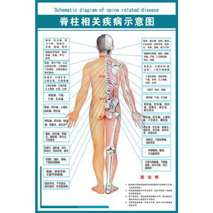 医学骨科挂图 脊柱相关疾病示意图 PVC高清写真防水耐用不掉色