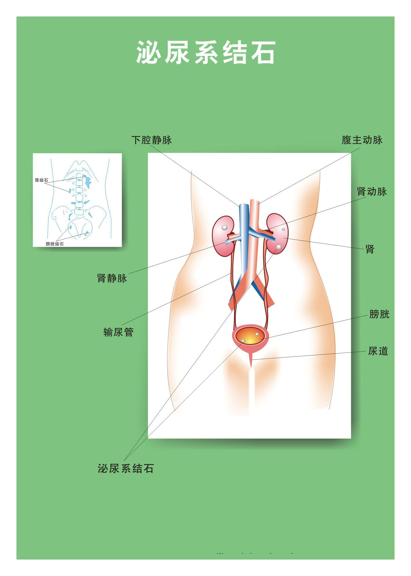 731海报印制展板写真喷绘贴纸293医院结石海报3泌尿系结石