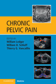 【预订】Chronic Pelvic Pain
