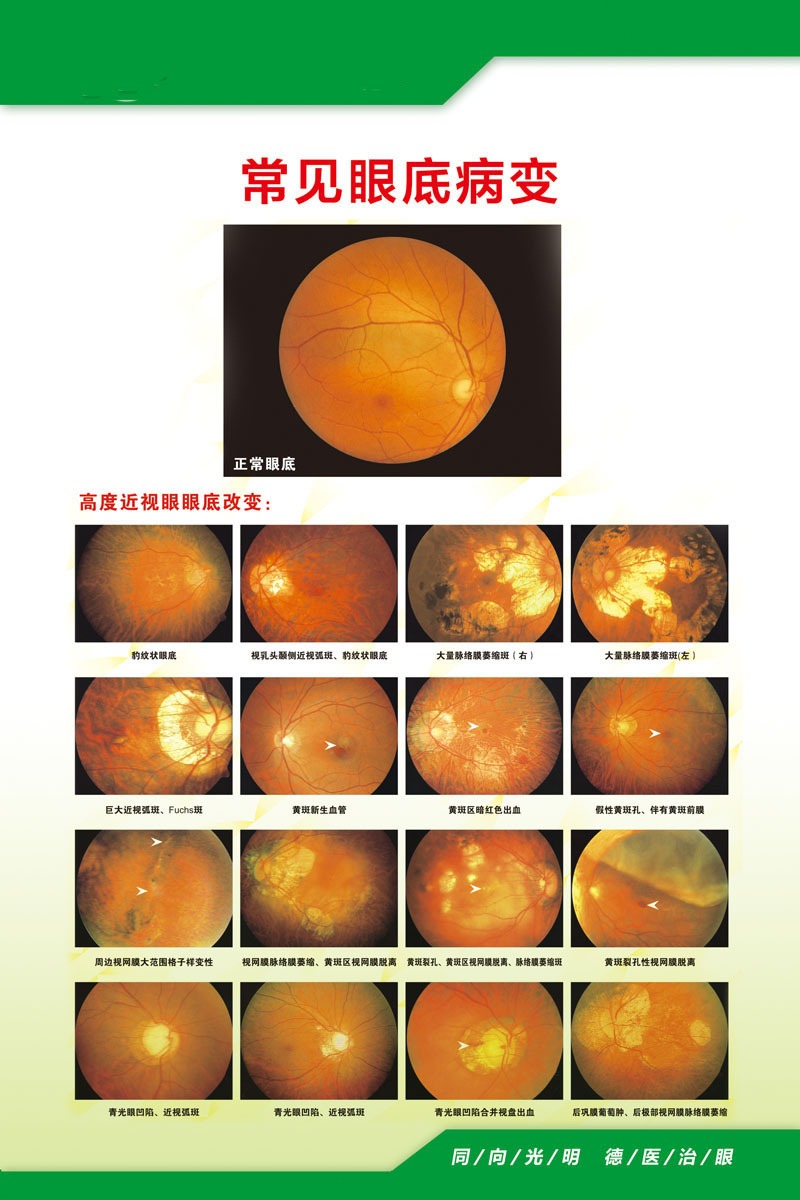 732海报印制展板写真喷绘贴纸970眼科常见眼底病变图