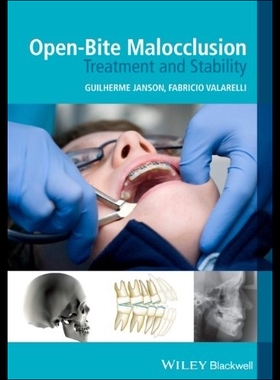【预售】Open-Bite Malocclusion: Treatment and