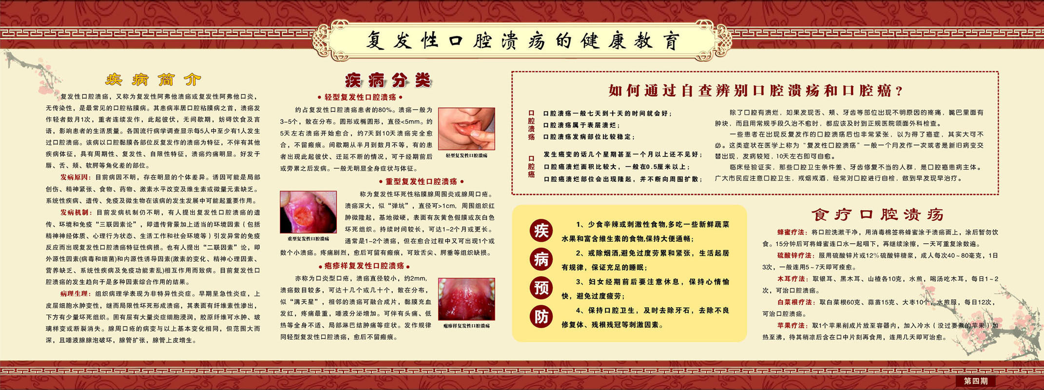 728海报印制展板写真喷绘贴纸305医院健康教育复发性口腔溃疡zip