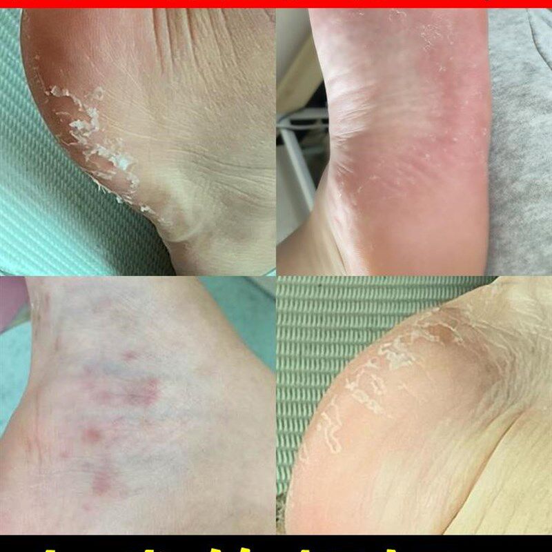 瘙痒中药皮肤湿疹克星泡脚草本去本草儿童真菌脱皮治脚气的药杀菌