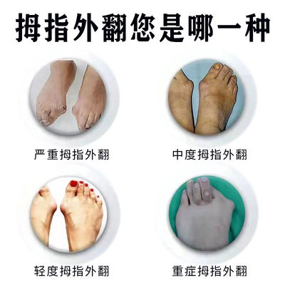 推荐拇指外翻膏治疗大脚骨脚趾矫正器拇指外翻肌大指姆重叠矫正贴