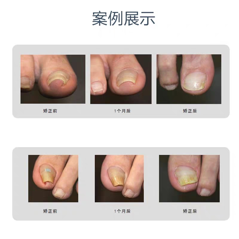 拉拉贴嵌甲快速矫正贴片胶水软化剂甲勾正甲贴