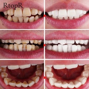 Mousse Whiteni Teeth 速发5PCS Whitening Removes RtopR Stains