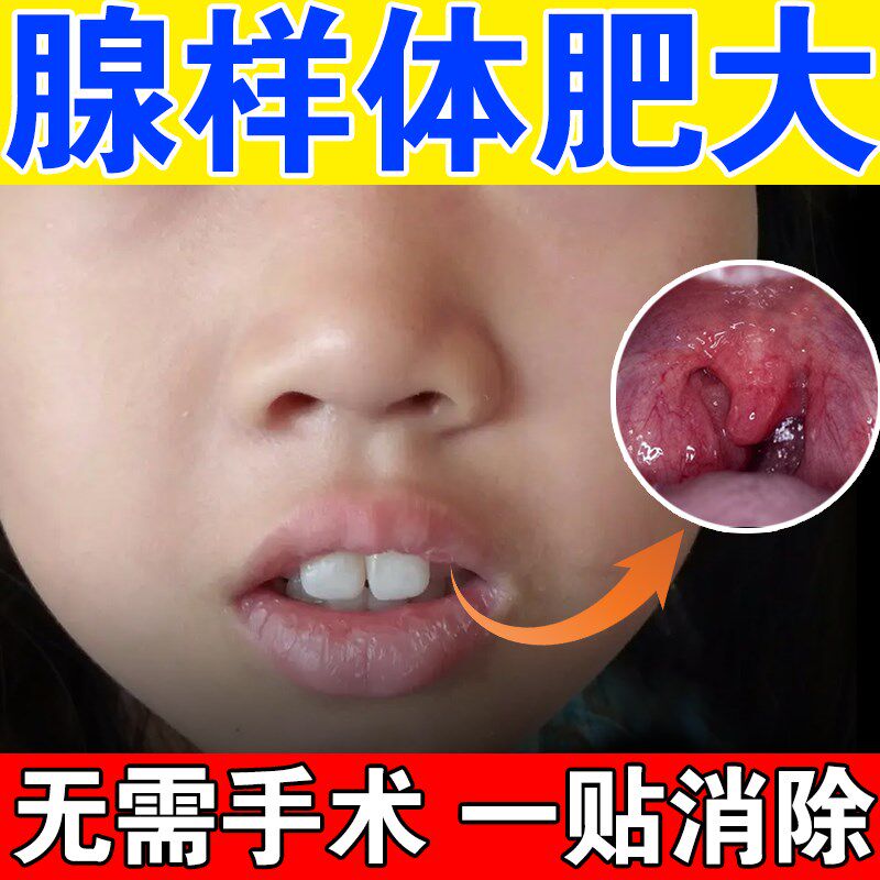 速发腺样体肥大调理中药贴儿童打呼噜宝宝张嘴呼吸打鼾腺样体肥大