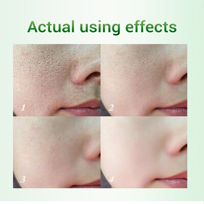 新品20ml Salicylic Acid Pores Refining Cream Shrink Pore Imp