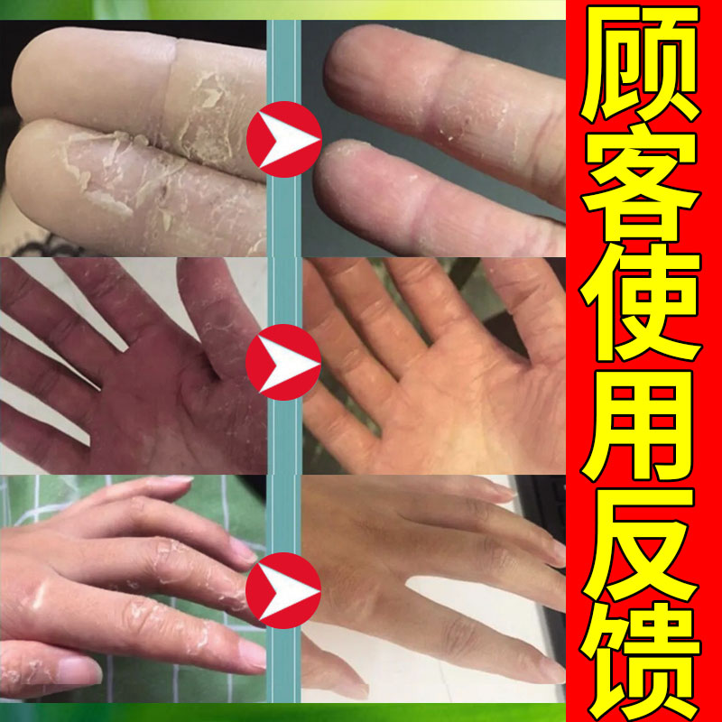 止脚脱皮药治专膏真菌感染手脚干裂手指起水泡掉皮手痒杀菌神器
