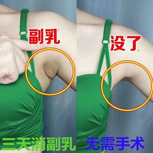 工厂销【屈d臣氏推荐收副乳】去副乳神器疏通腋下淋巴肿大结节通