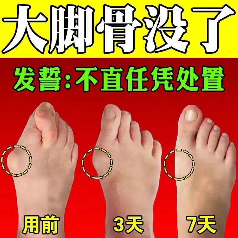热销拇指外翻贴母指外翻矫正贴脚趾重叠防磨拇外翻大脚骨外翻贴专