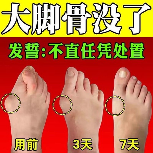 热销拇指外翻贴母指外翻矫正贴脚趾重叠防磨拇外翻大脚骨外翻贴专