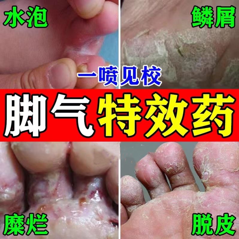 脚底脱皮药膏干裂皮喷剂真菌外感癣藓肤病专用顽固用染皮炎神经性