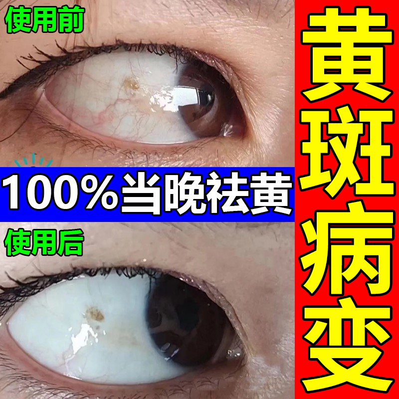 新品去除眼底黄斑病变滴眼液眼睛发黄混浊眼白出血眼球清澈去黄眼