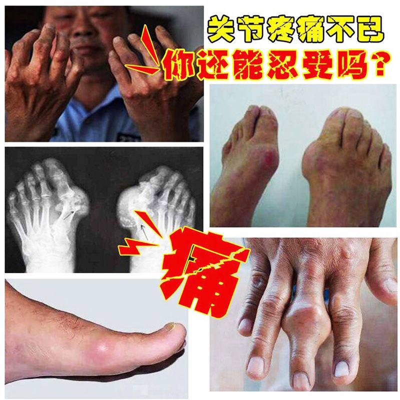 网红手指关节粗大修复美手神器僵硬类风湿性关节炎疼痛变形肿大专