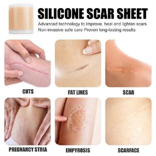 Scar Remoeal Patch SiliconefSc 50cma Svl adhesive