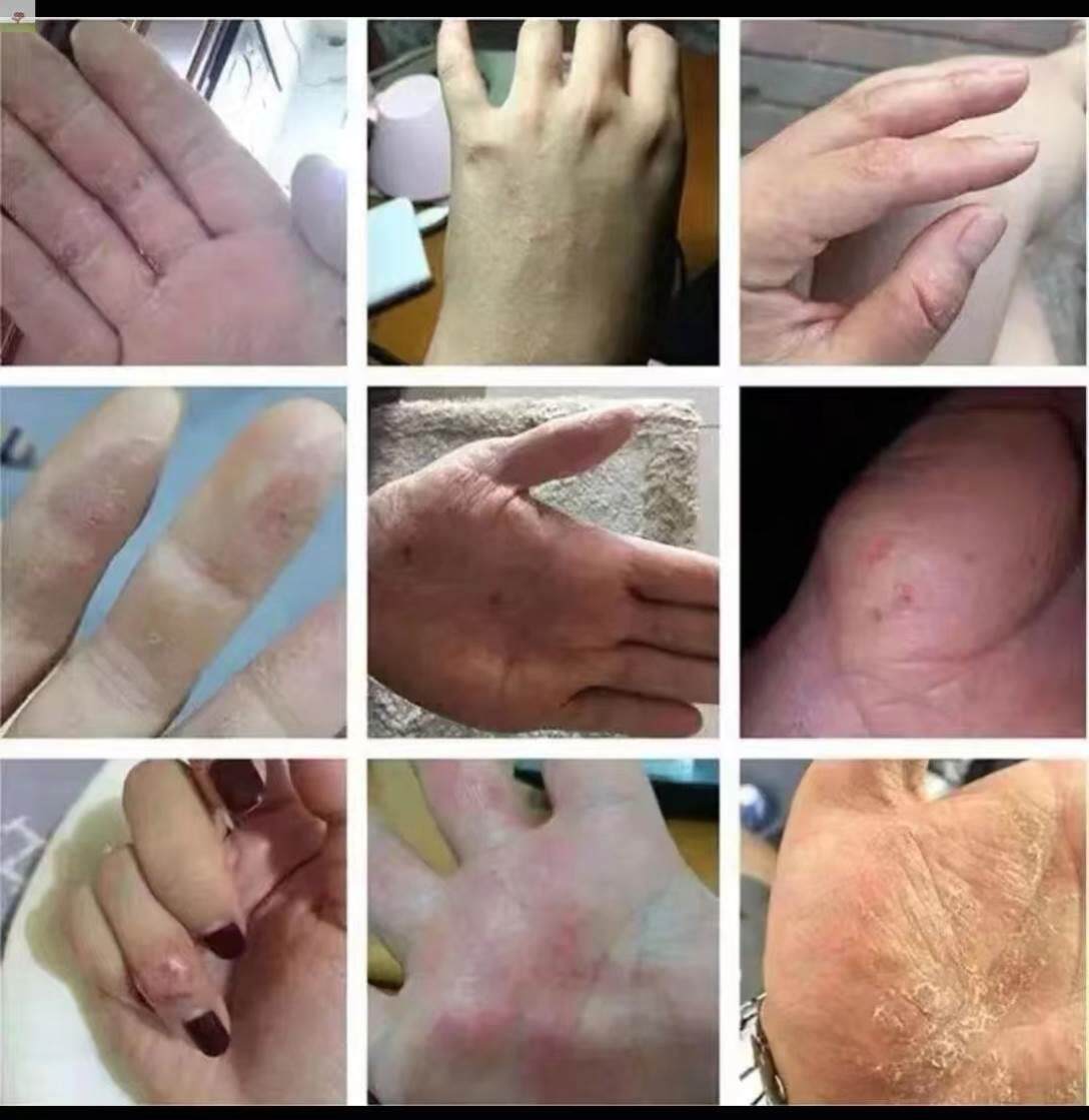 汗疱疹汗孢疹汗泡疱n疹疹膏汉汗状泡药手上小水疱克星鹅掌风专用