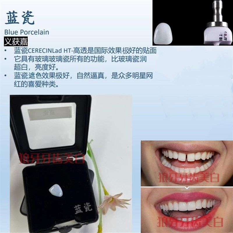 全瓷贴片义获嘉超薄超硬全瓷贴面修复牙缝黄牙氟斑牙y德国进口美