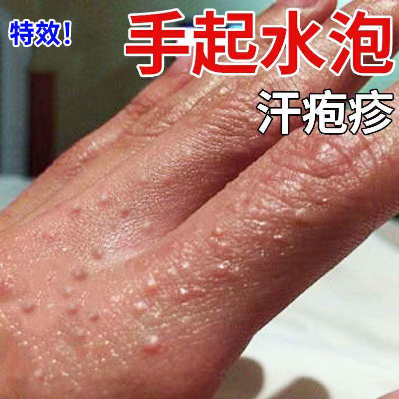 手上小水泡汗泡药膏真菌感染手气药膏汗状专用软膏汗孢a