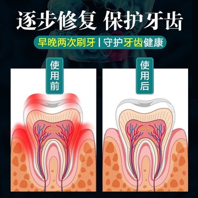 【专攻牙松动】牙齿松动牙X退缩出血肿痛咬无合力R固齿专用牙膏龈