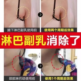 速发【最快7天收副乳】副乳消除贴云南腋下淋巴结节解散膏 去副乳