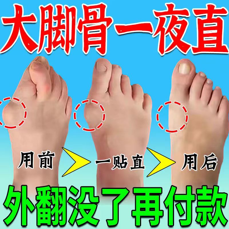 工厂销拇指外翻贴母指外翻矫正贴脚趾重I叠防磨大脚骨外翻贴拇外