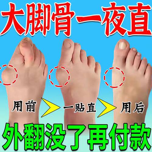 工厂销拇指外翻贴母指外翻矫正贴脚趾重I叠防磨大脚骨外翻贴拇外