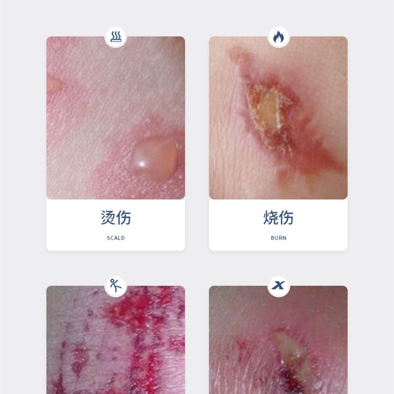 推荐美宝湿润烧伤烫伤膏外用皮肤B开水电焊壁炉压力锅儿童婴儿烫