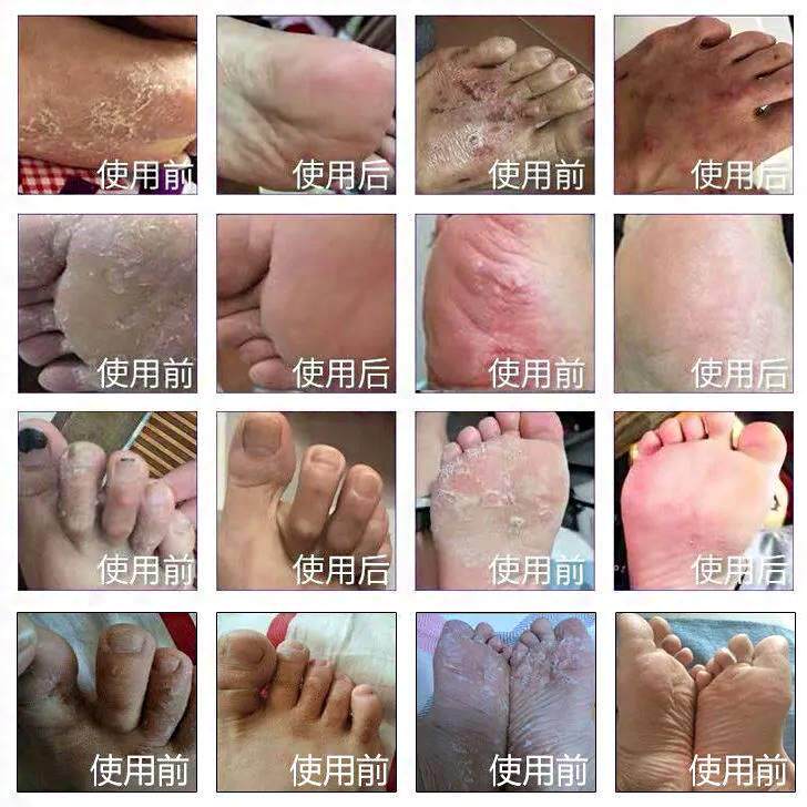 现货速发窝状角质松解症脚底马蜂窝烂脚丫药脱皮糜烂脚趾缝烂痒专