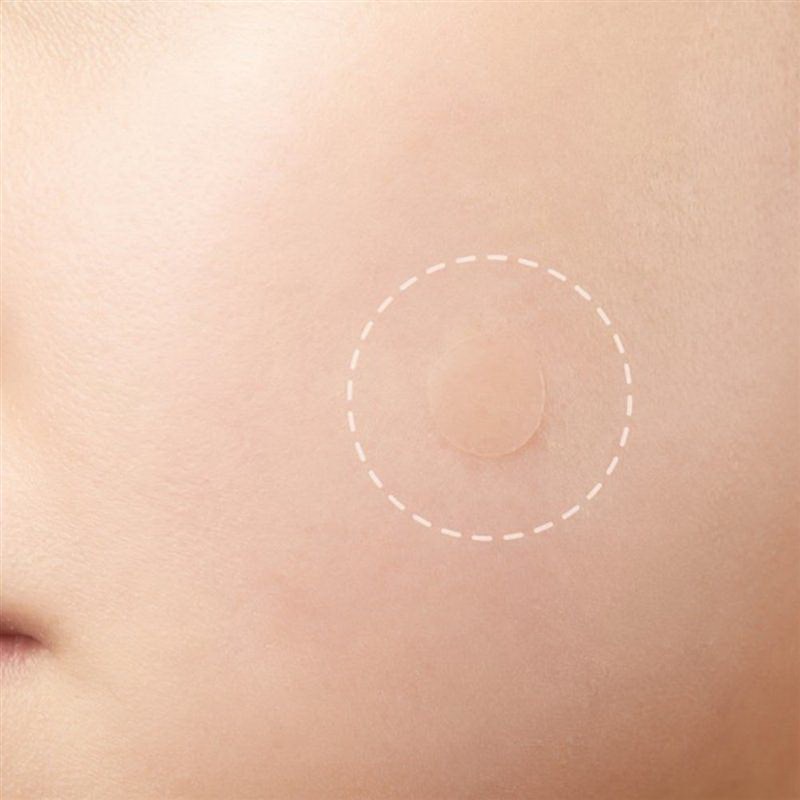 推荐36pcs/sheet Skin Tag Pimple Remover Tools Wart Treatment