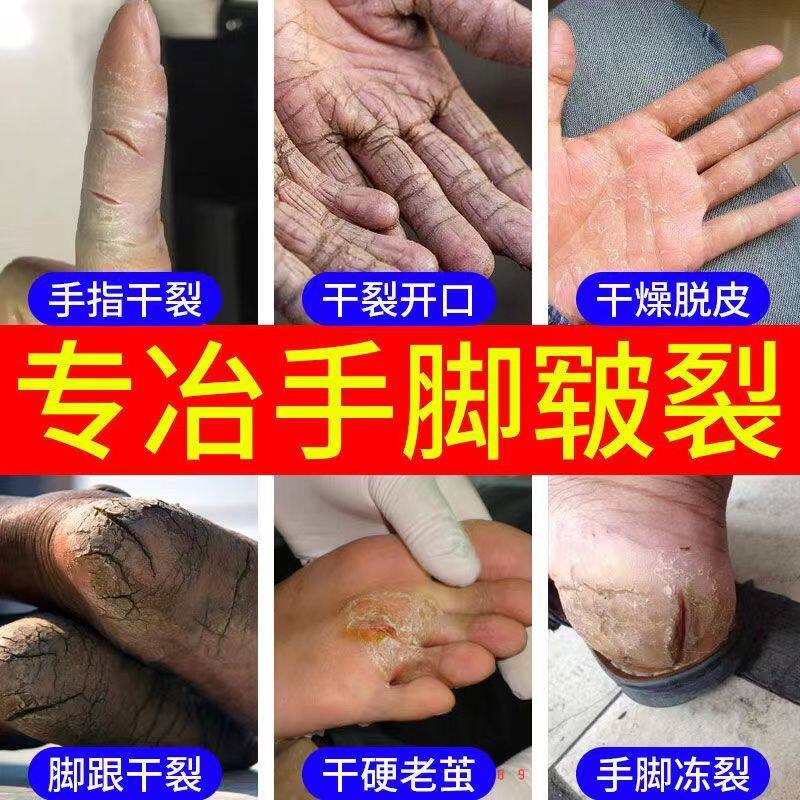 买【3送2】专治脚后跟开裂手脚开裂裂皮真菌感染冻疮蜕口子皲裂膏