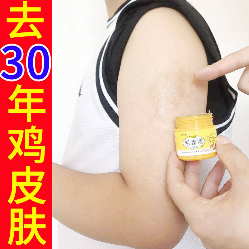 现货速发鸡皮肤疙瘩毛囊角化药膏去毛囊角质去腿上鸡皮疙瘩鱼鳞蛇