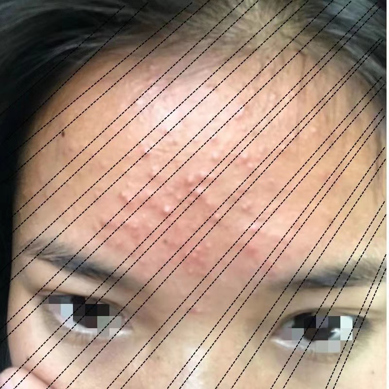 额头上长痘痘头部额头闭口小疙瘩粉刺脸上有小颗粒疙瘩长痘痘粉刺