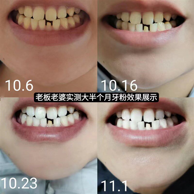 益生菌牙粉速效去黄去口臭除黄牙渍去牙结石神器炫白洁齿牙齿美白