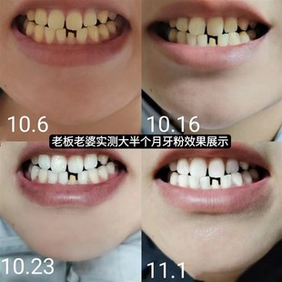 益生菌牙粉速效去黄去口臭除黄牙渍去牙结石神器炫白洁齿牙齿美白